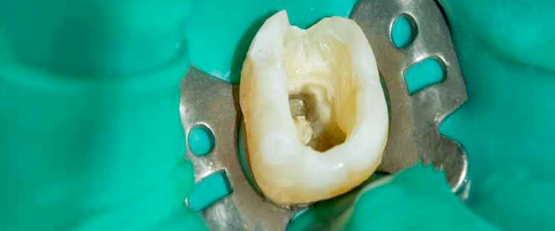 What Do Endodontists Do Besides Root Canals?