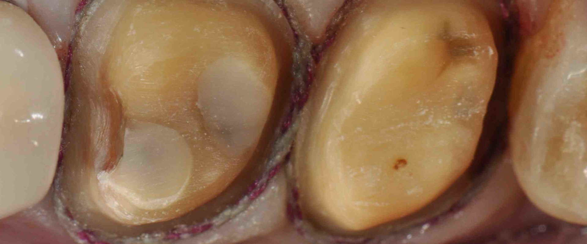 Can an Endodontist Perform a Root Canal Through a Crown?