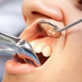 Can an Endodontist Perform an Extraction?