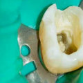 What Do Endodontists Do Besides Root Canals?