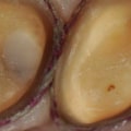 Can an endodontist do a root canal through a crown?