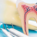 Do endodontists do crowns after root canal?
