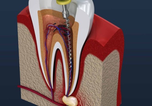 Do endodontists do more than root canals?