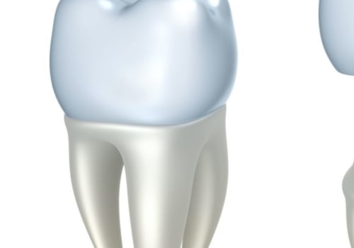 Do Endodontists Perform Temporary Crowns?