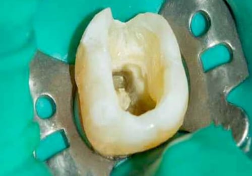 What do endodontists do besides root canals?