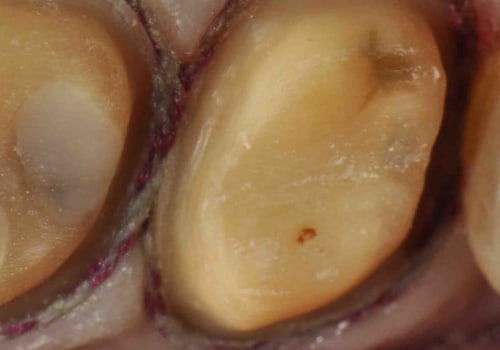 Can an endodontist do a root canal through a crown?